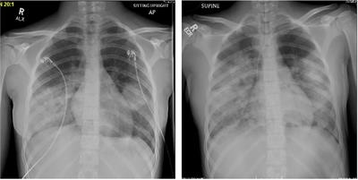 Plasma cell free next-generation sequencing detects an unusual pneumonia pathogen in an immunocompetent adolescent with acute respiratory distress syndrome